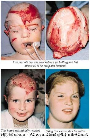 pit_bull_attack picture_child attacked by pit bull dog